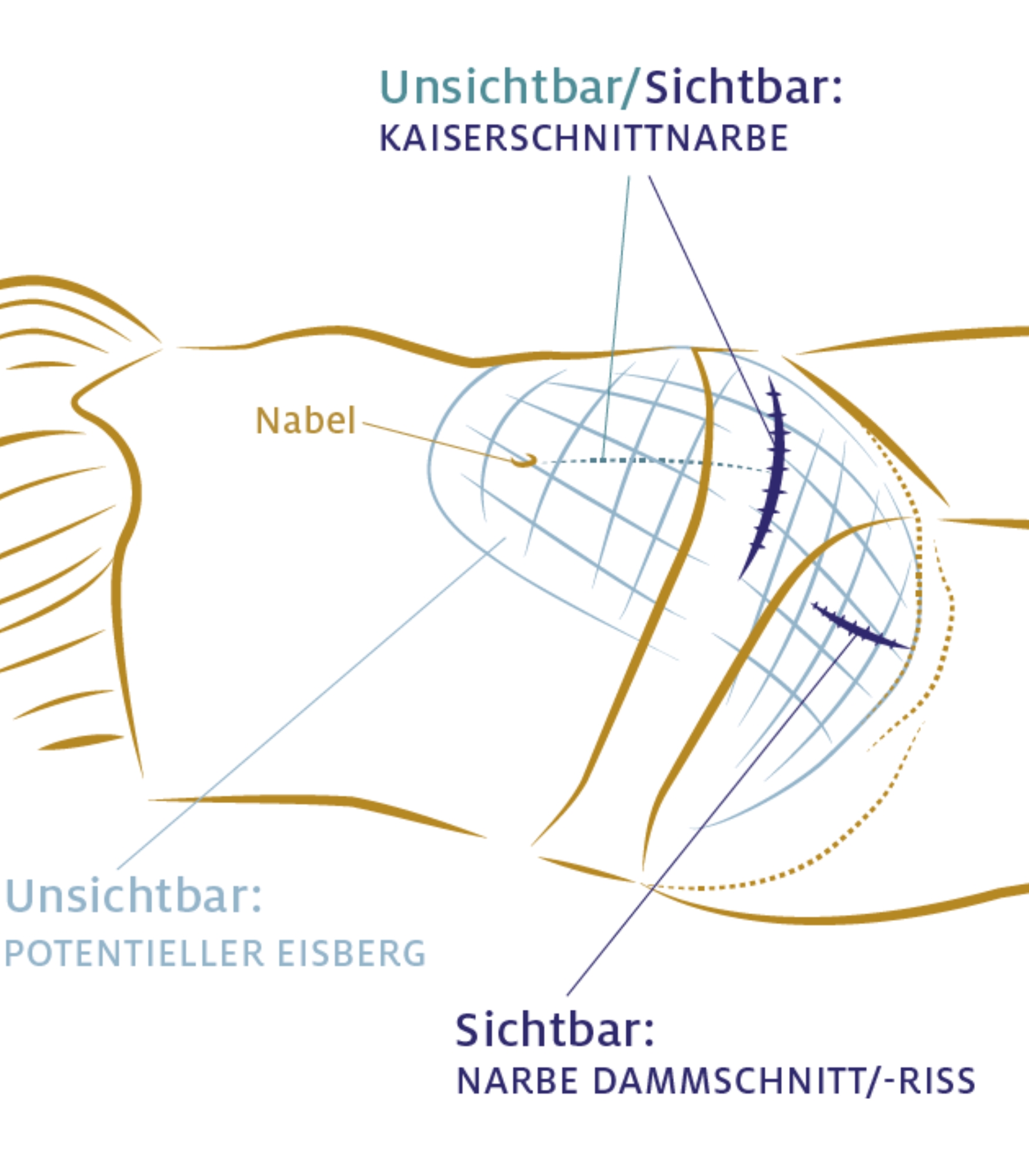 Skizze_Frau_Kaiserschnittnarbe